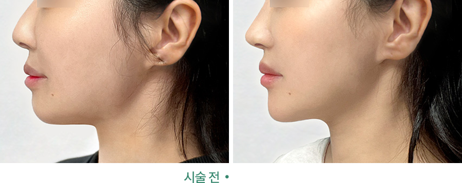 전후사진