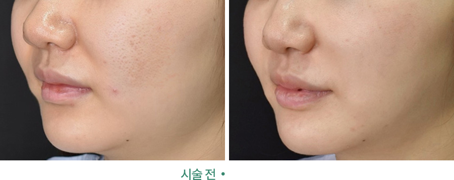전후사진