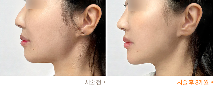 전후사진